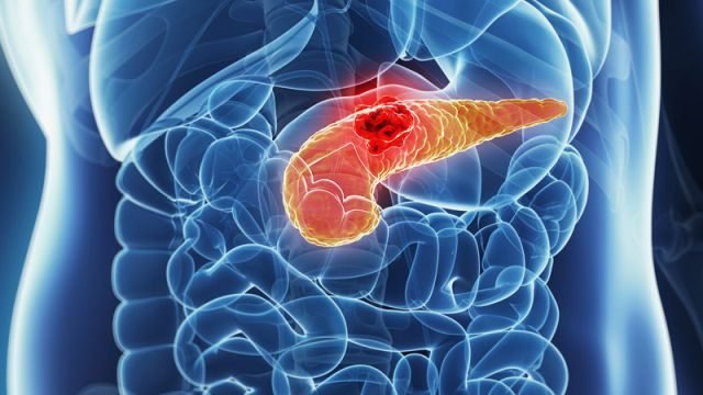 dt_140626_pancreas_cancer_800x600