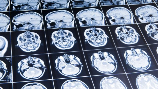 extra_large-1487346123-brain-scan