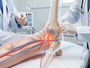 Нова минимално инвазивна процедура може да ја одложи замената на коленото